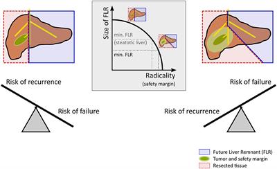 Computational Modeling in Liver Surgery